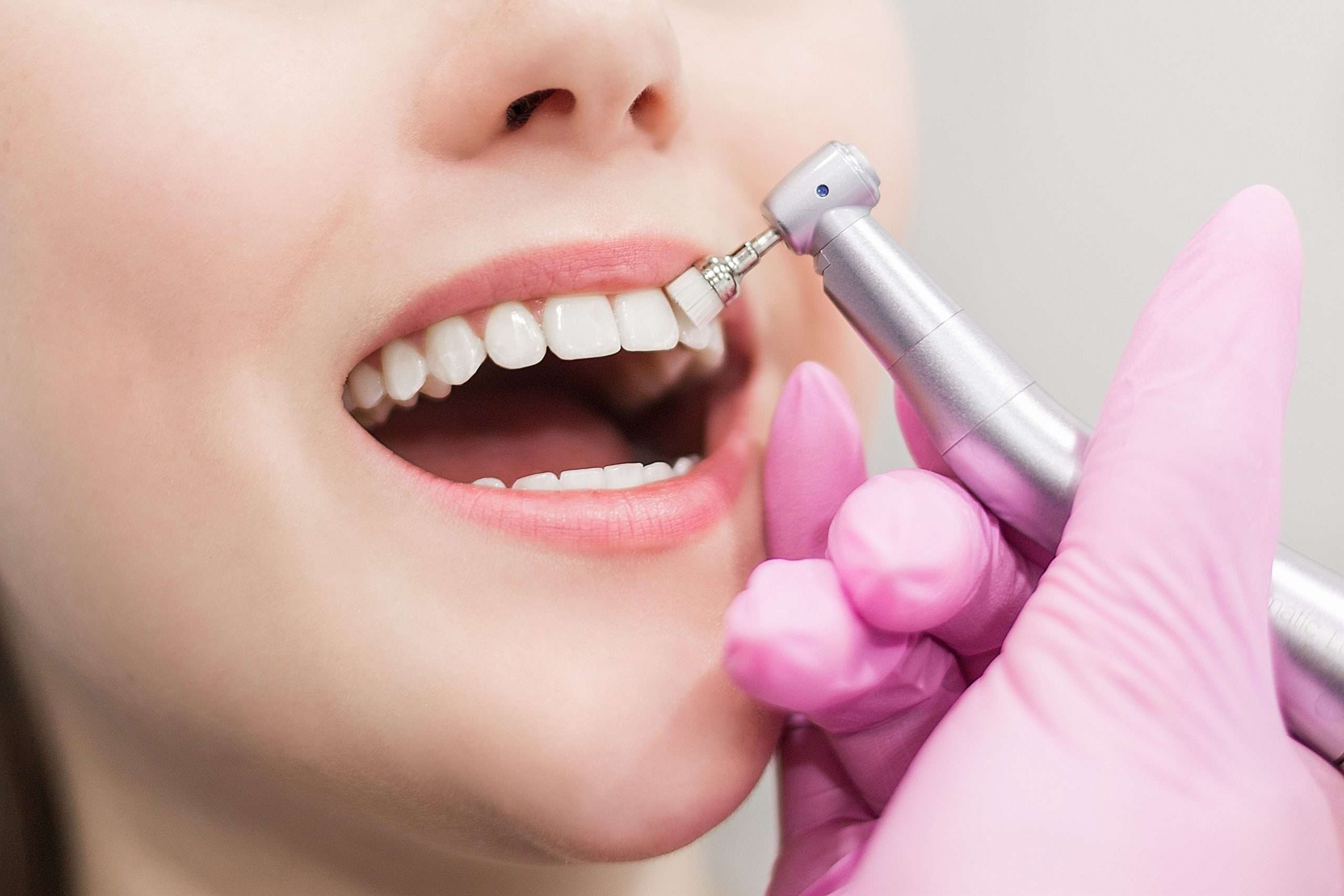dentist brushes teeth young girl teeth whitening 2022 11 15 05 20 50 utc scaled